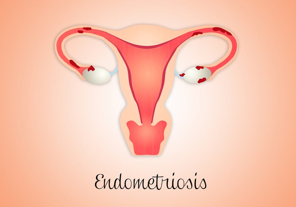 Endometriosis Treatment Through Diet