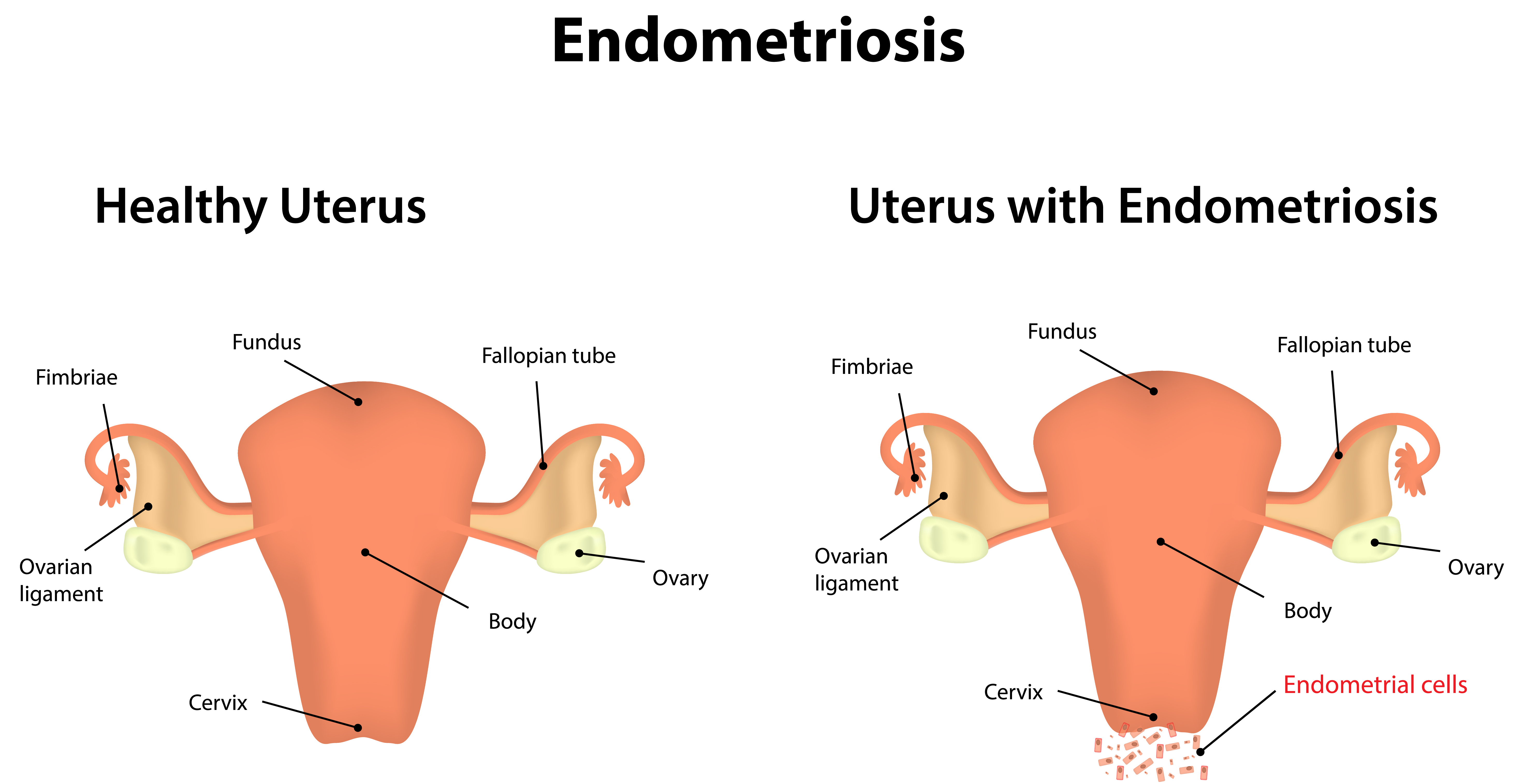 Endometriosis A top cause of infertility Embry Women's Health