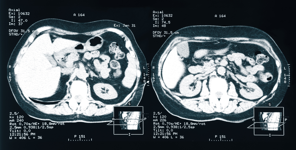 ENZIAN Score and MRI Allow Accurate Detection of Deep Endometriosis
