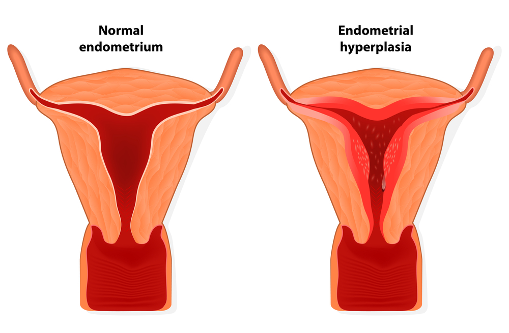 Dienogest Found to Inhibit Abnormal Estrogen Production, Alleviate Endometriosis-Associated Symptoms