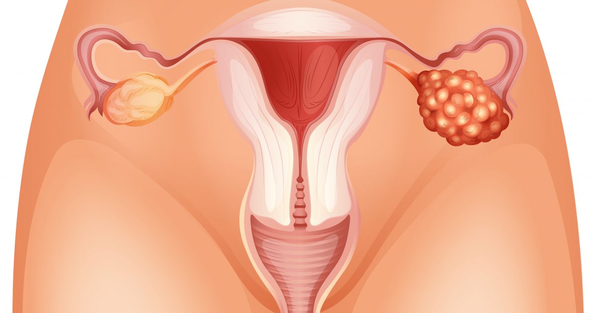 Endometriosis Stages Endometriosis News