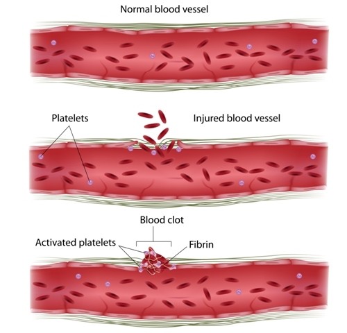 In Endometriosis, Blood Platelets May Work in Concert with Lesions to Promote Disease