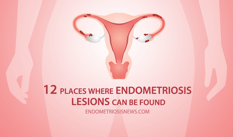 endometriosis lesions