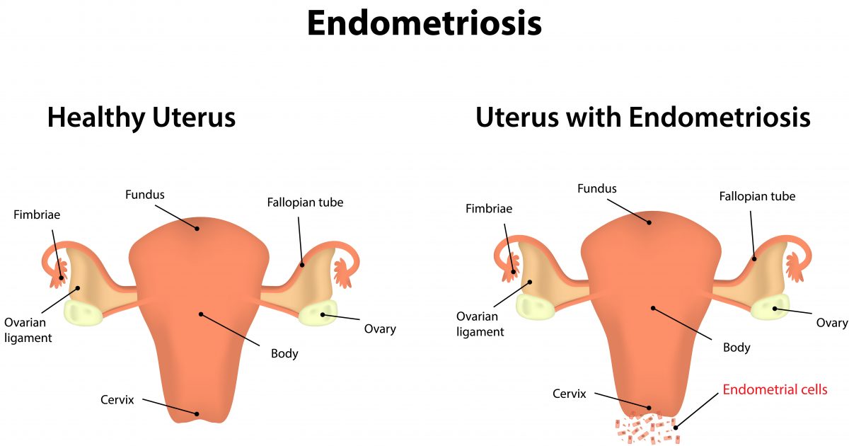 In Endometriosis Study, Enzyme Found to Regulate Hormone-Dependent ...