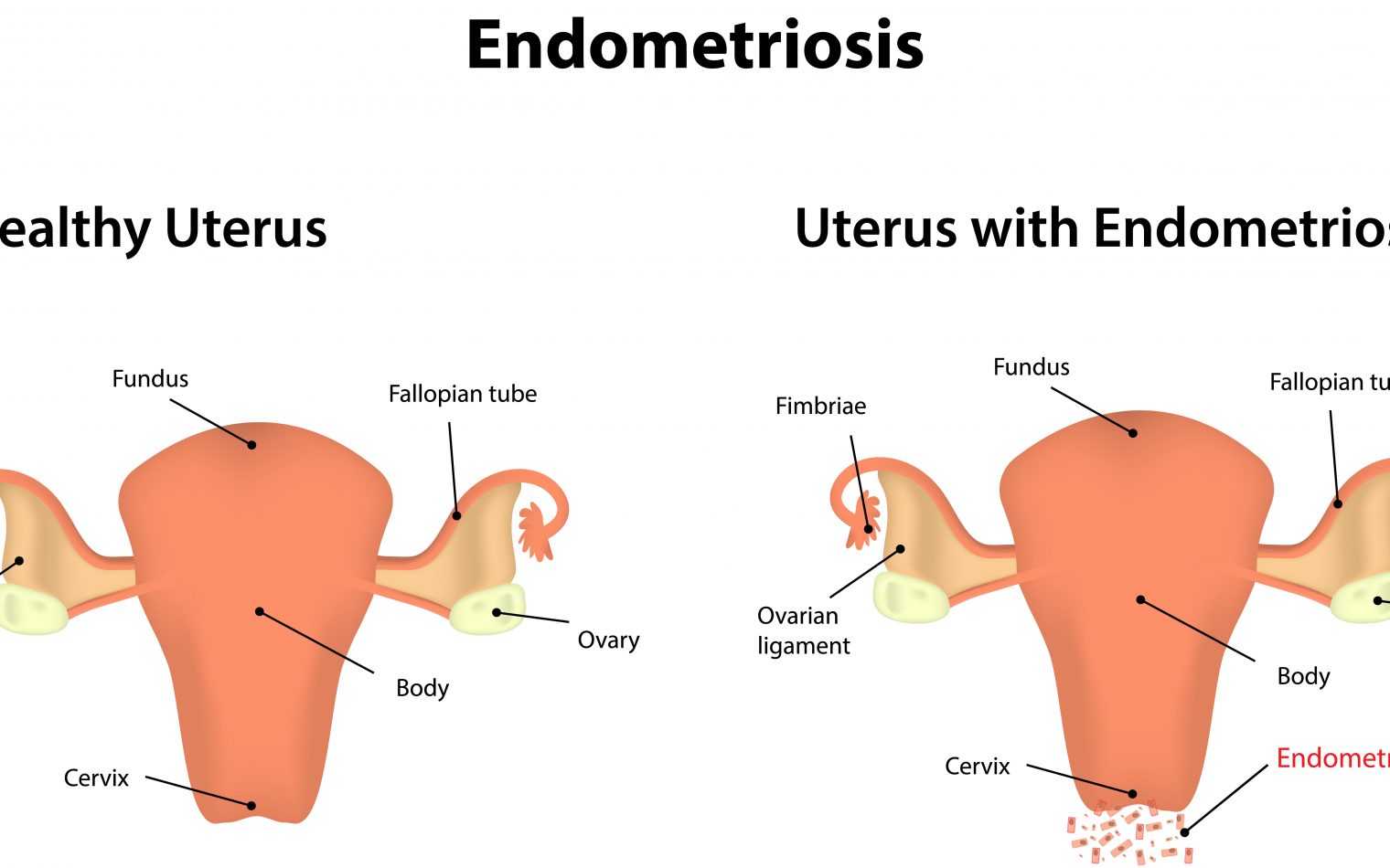 Sex for Women with Endometriosis Significantly Better After Surgery -  Endometriosis News