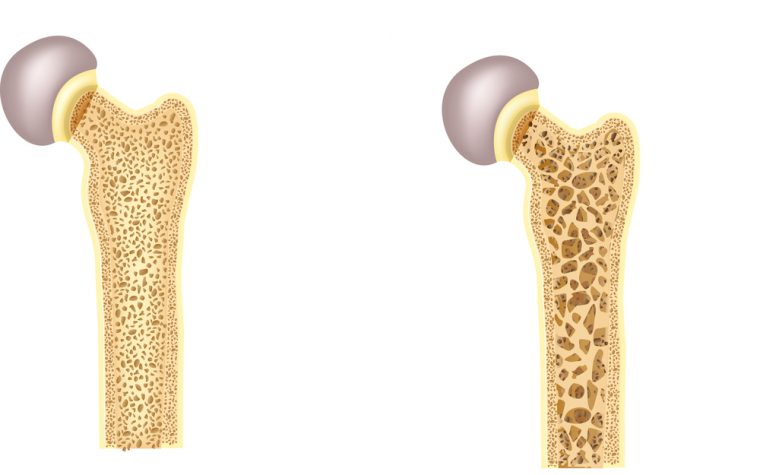 osteoporosis treatment