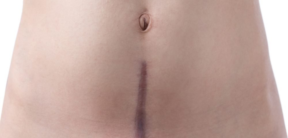 Endometriosis of Abdominal Wall May Turn into Cancer After C-Section, Case Report Suggests