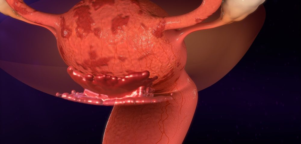MIT Researcher Develops 3D Model for Studying Endometriosis