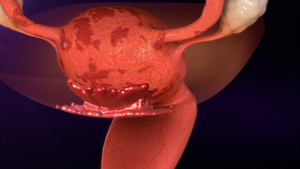 Endometriosis Research Could Get Boost from MIT's 3D Tissue Culturing ...