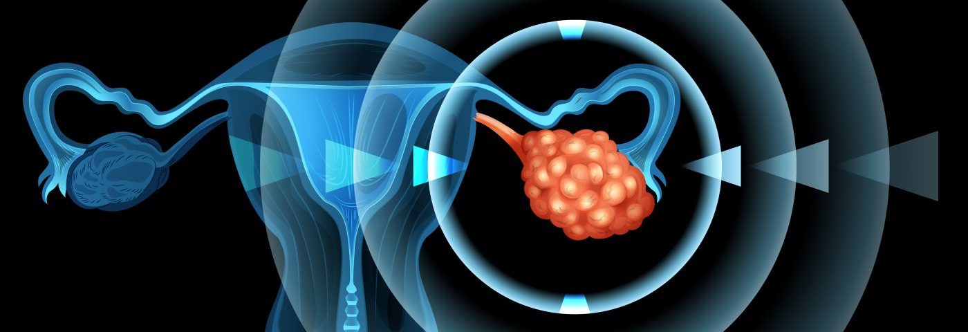 Stress-activated Pathway May Play Role in Ovarian Cancer Risk in Endometriosis, Study Finds