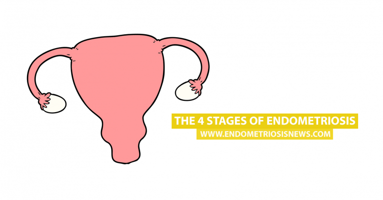 The 4 Stages Of Endometriosis - Endometriosis News