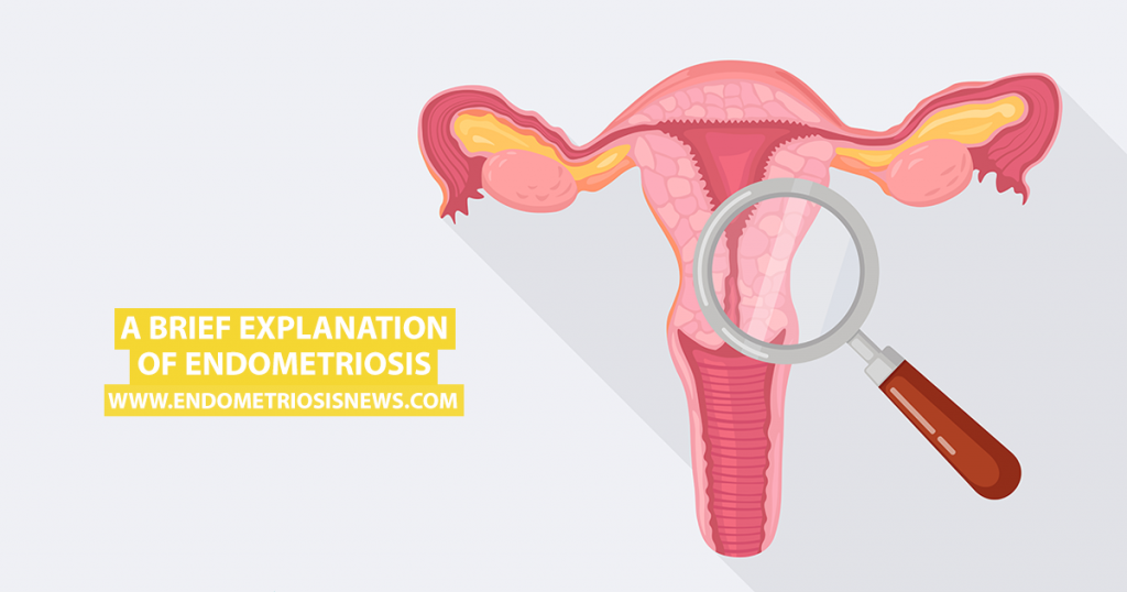 A Brief Explanation of Endometriosis Endometriosis News
