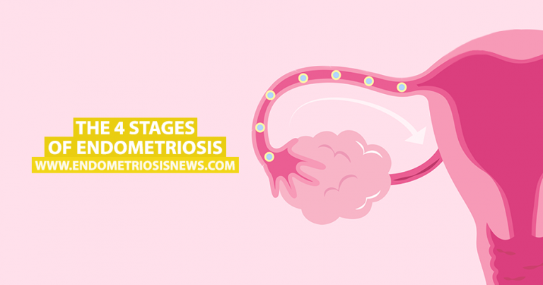 The 4 Stages of Endometriosis - Endometriosis News